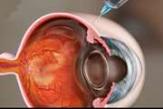 Prevalence of Refractive Errors and Associated Factors in the Population of the Eye Cohort Study in Southeast Iran