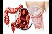 Association between prediagnostic risk factors and survival after colorectal cancer diagnosis in Golesten cohort study