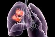 Association between socioeconomic position and lung cancer incidence in 16 countries: a prospective cohort consortium study