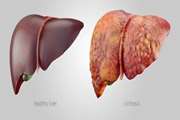 Dietary protein intake and mortality among survivors of liver cirrhosis: a prospective cohort study