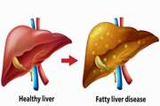 Effects of a polypill on circulating levels of resistin and visfatin in men with non-alcoholic fatty liver disease: A five-year clinical trial