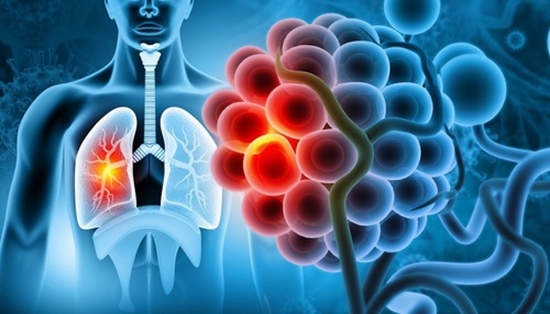 IMG_lung_cancer_cells {faces}
